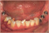 Zur Versorgung der Lücken werden ingesamt vier Implantate im Unterkiefer gesetzt und Zähne 44 und 45 zur Aufnahme von neuen Verblendungen präpariert.